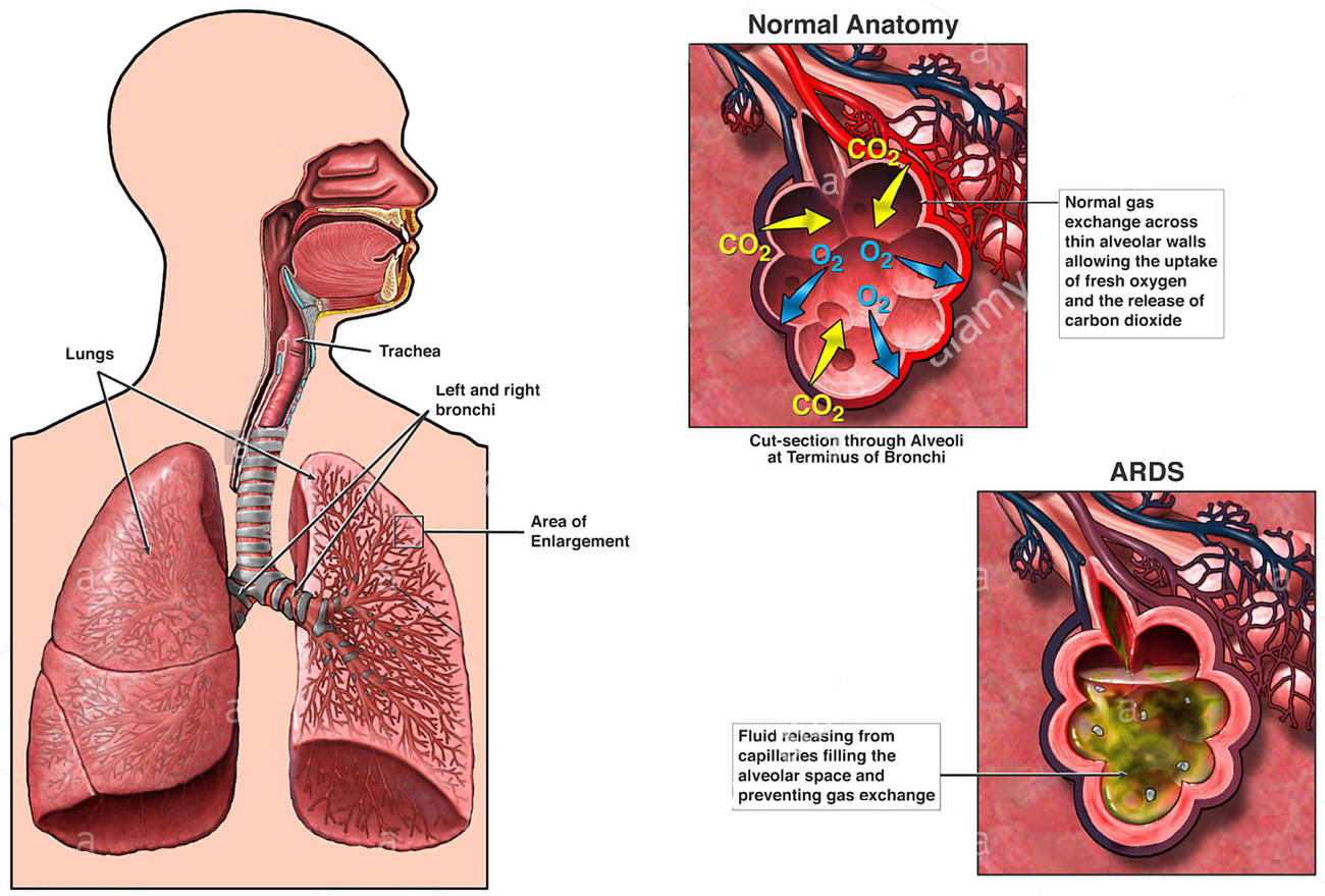 coronavirus-how-does-covid-19-affect-your-lungs